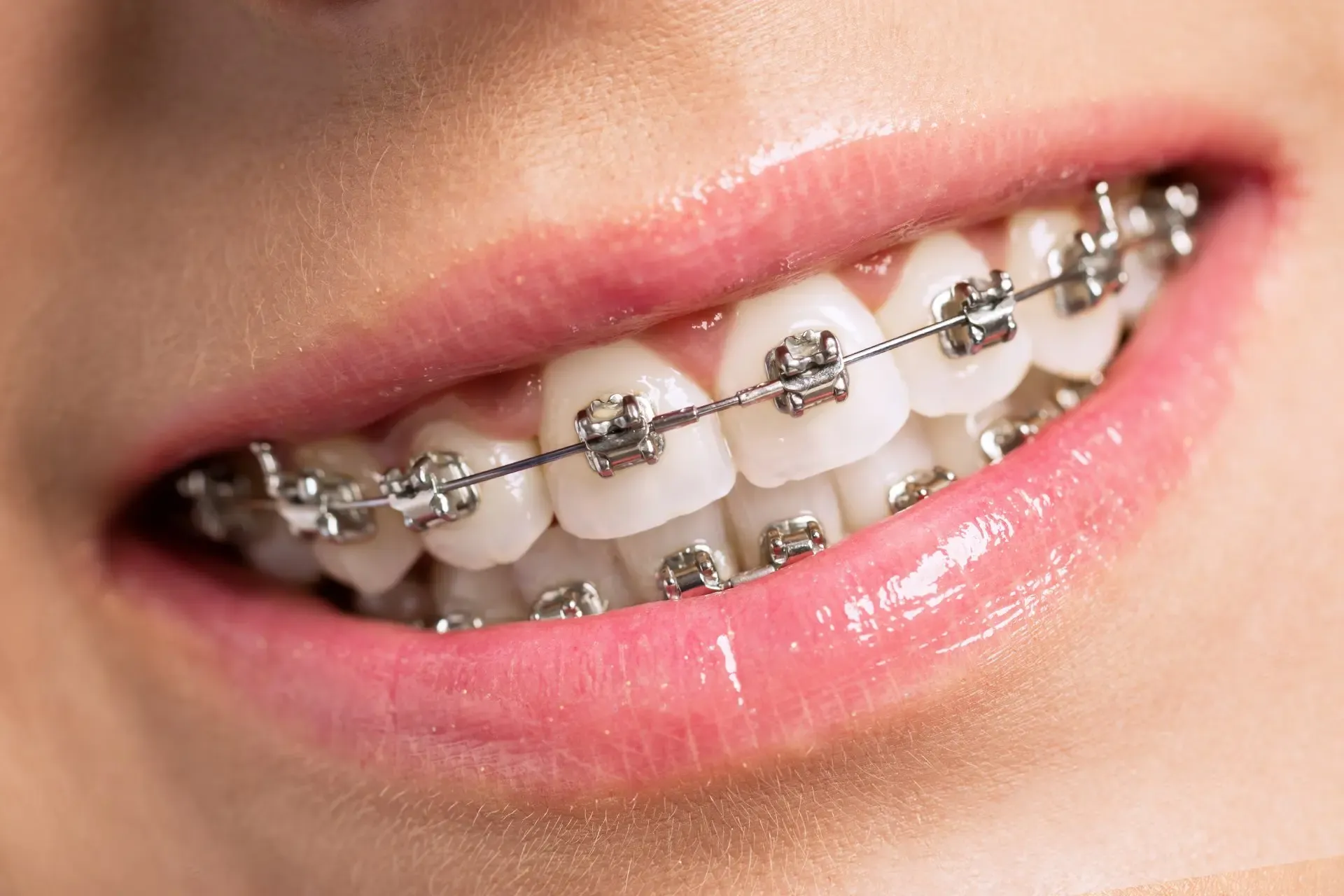 Primo piano di apparecchio fisso metallico con bracket sui denti di un bambino, alternativa all'ortodonzia precoce con attivatore di funzione.